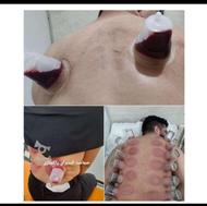 حجامت ، طب سوزنی ، امبدینگ