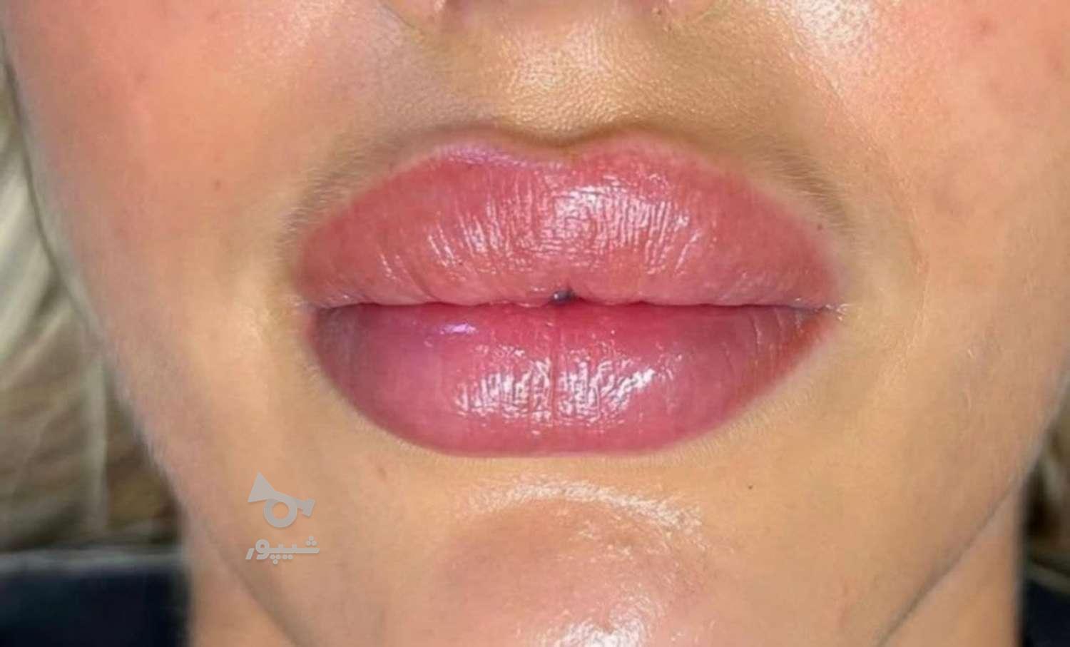 هیدرالیپس لب