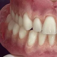 ساخت دندان مصنوعی