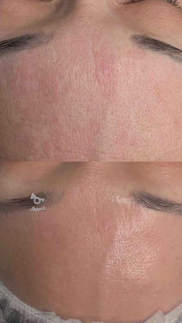 فیشیال، پاکسازی تخصصی صورت با تخفیف محدود