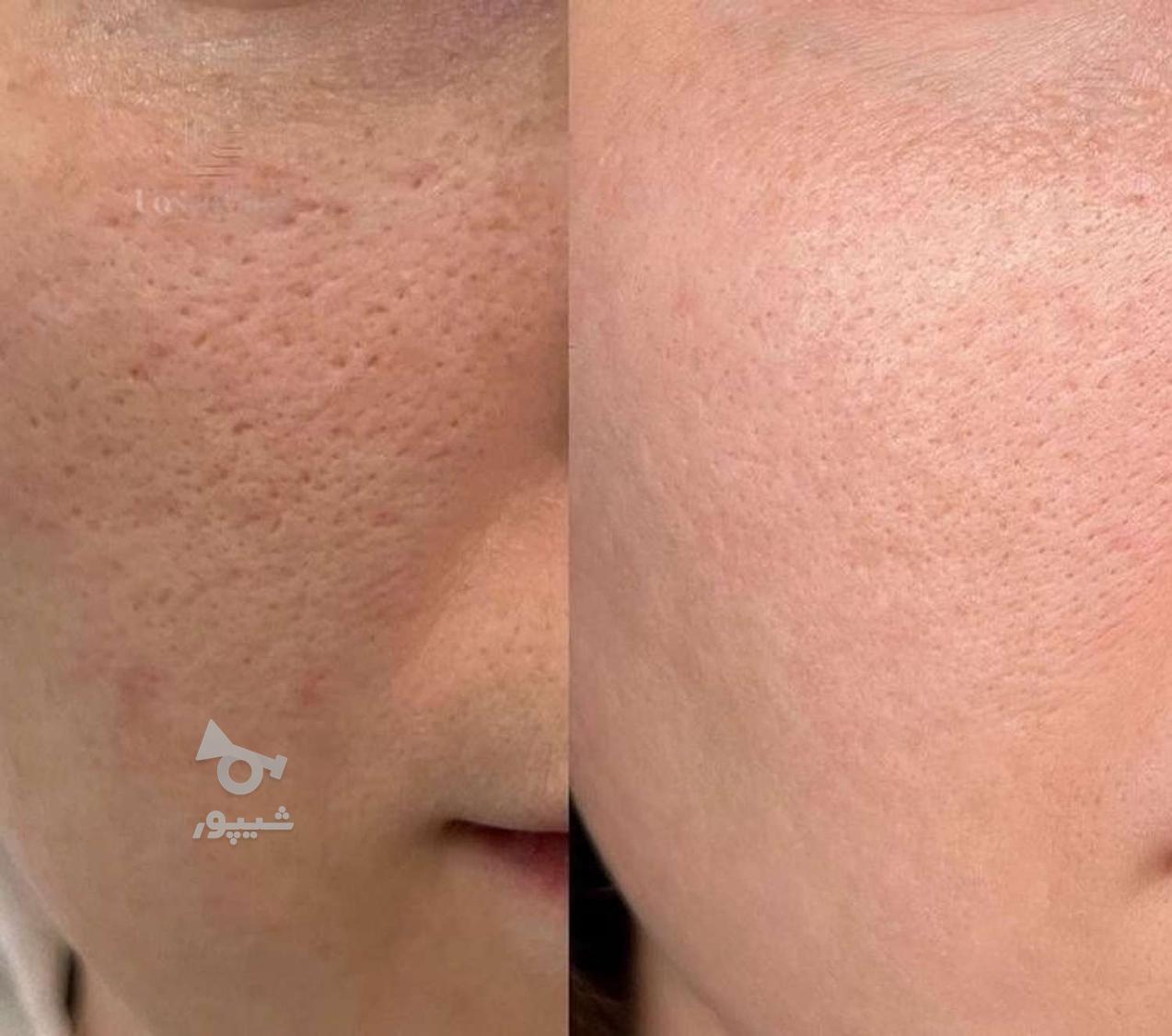 فیشیال، پاکسازی تخصصی صورت با تخفیف محدود