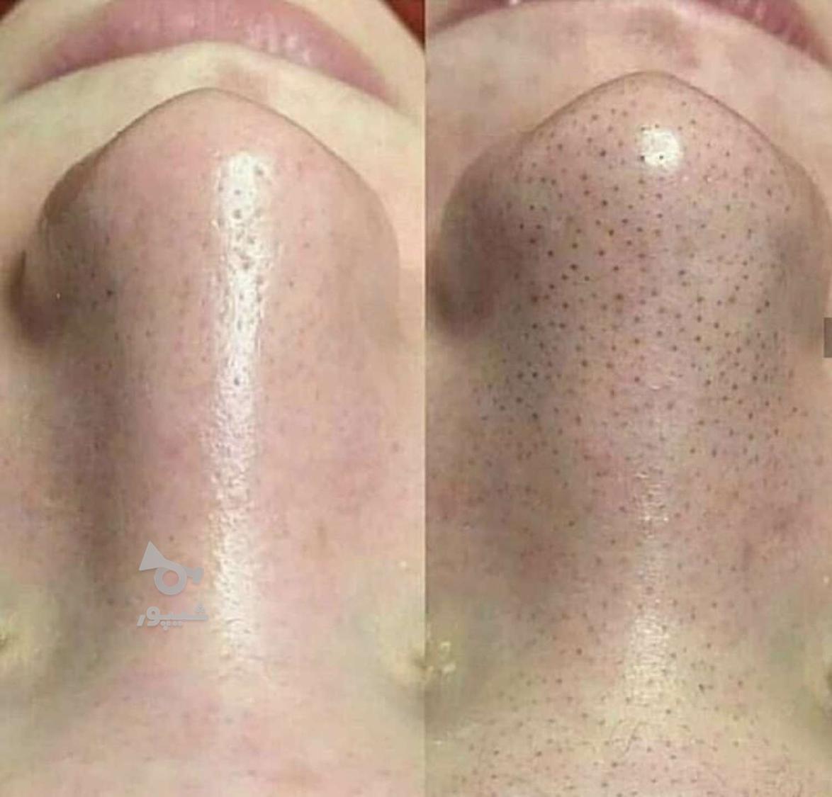 فیشیال، پاکسازی تخصصی صورت با تخفیف محدود