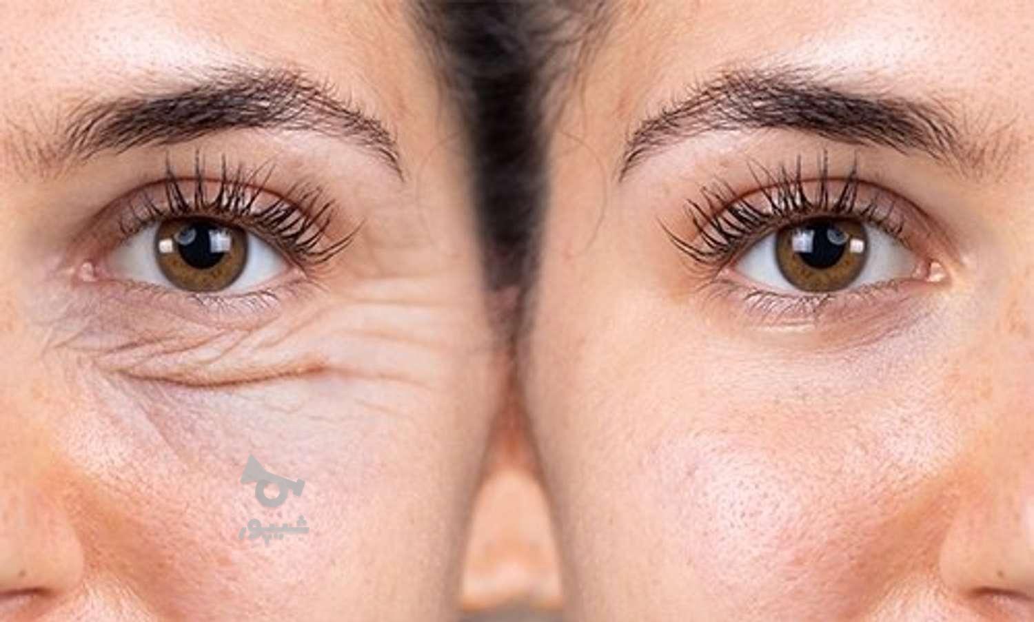 لیفت وجوانسازی پوست