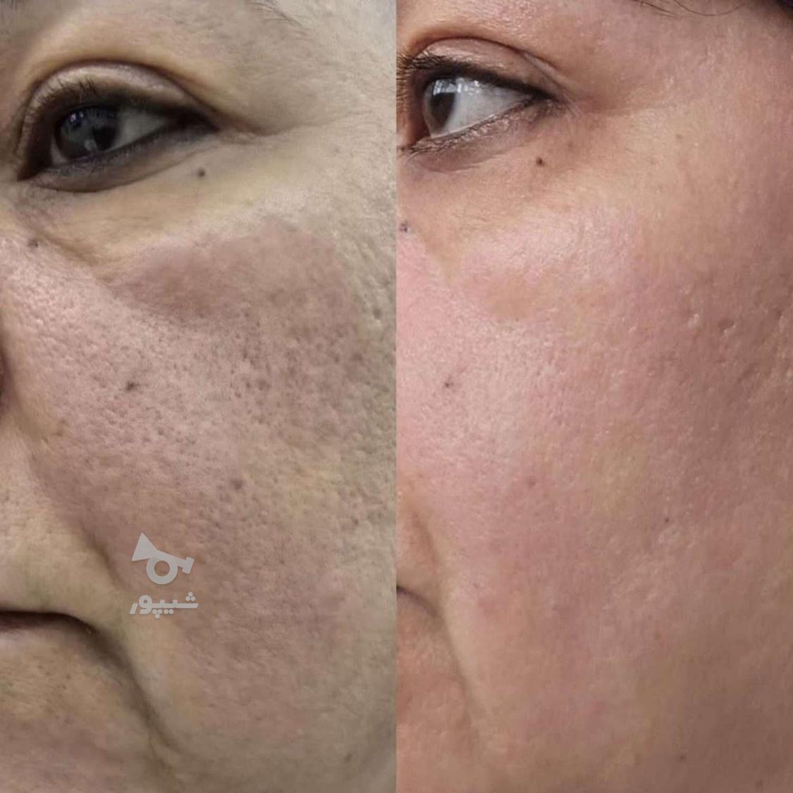 لیفت وجوانسازی پوست