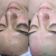 فیشیال صورت