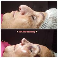 جراحی بینی بدون بیهوشی