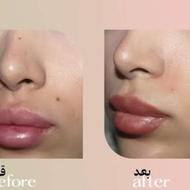 لیزر رفع خال