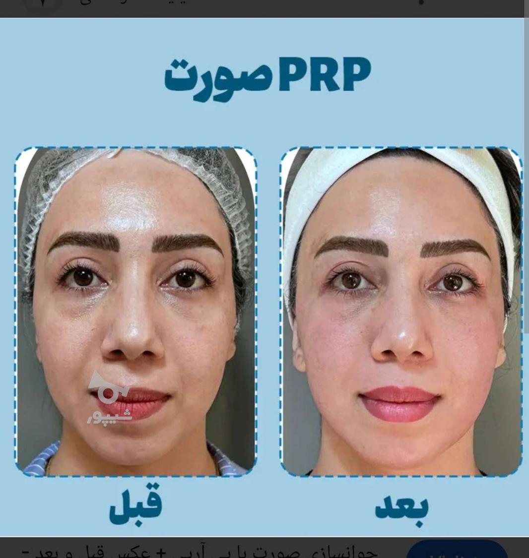 پی آر پی سر و صورت