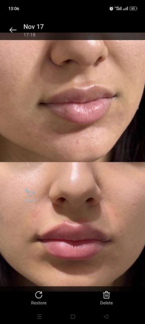 تزریق ژل وبوتاکس