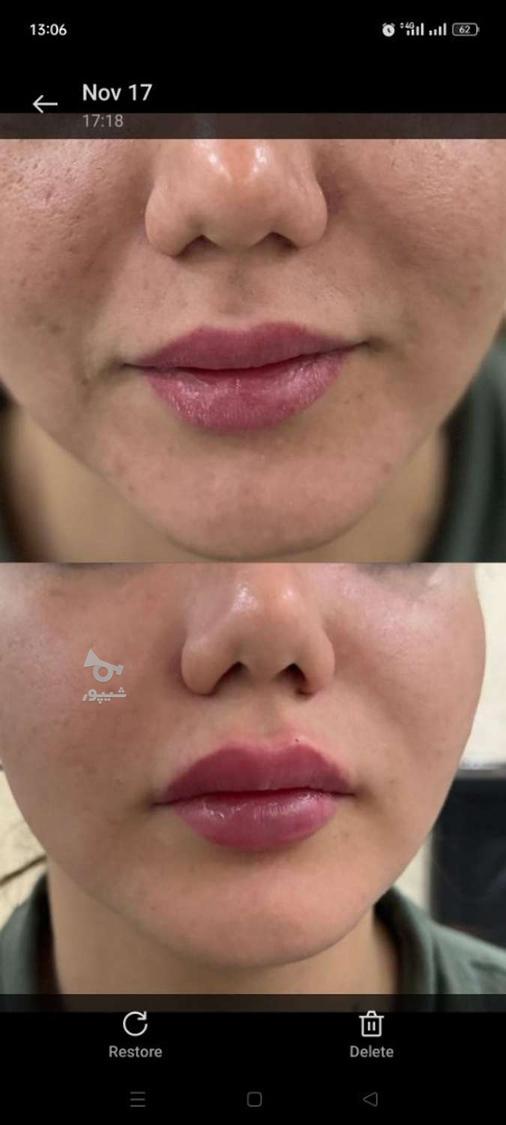 تزریق ژل وبوتاکس