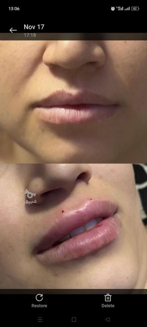 تزریق ژل وبوتاکس