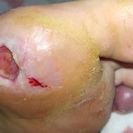 درمان زخم‌های دیابتی،زخم بستر،سوختگی