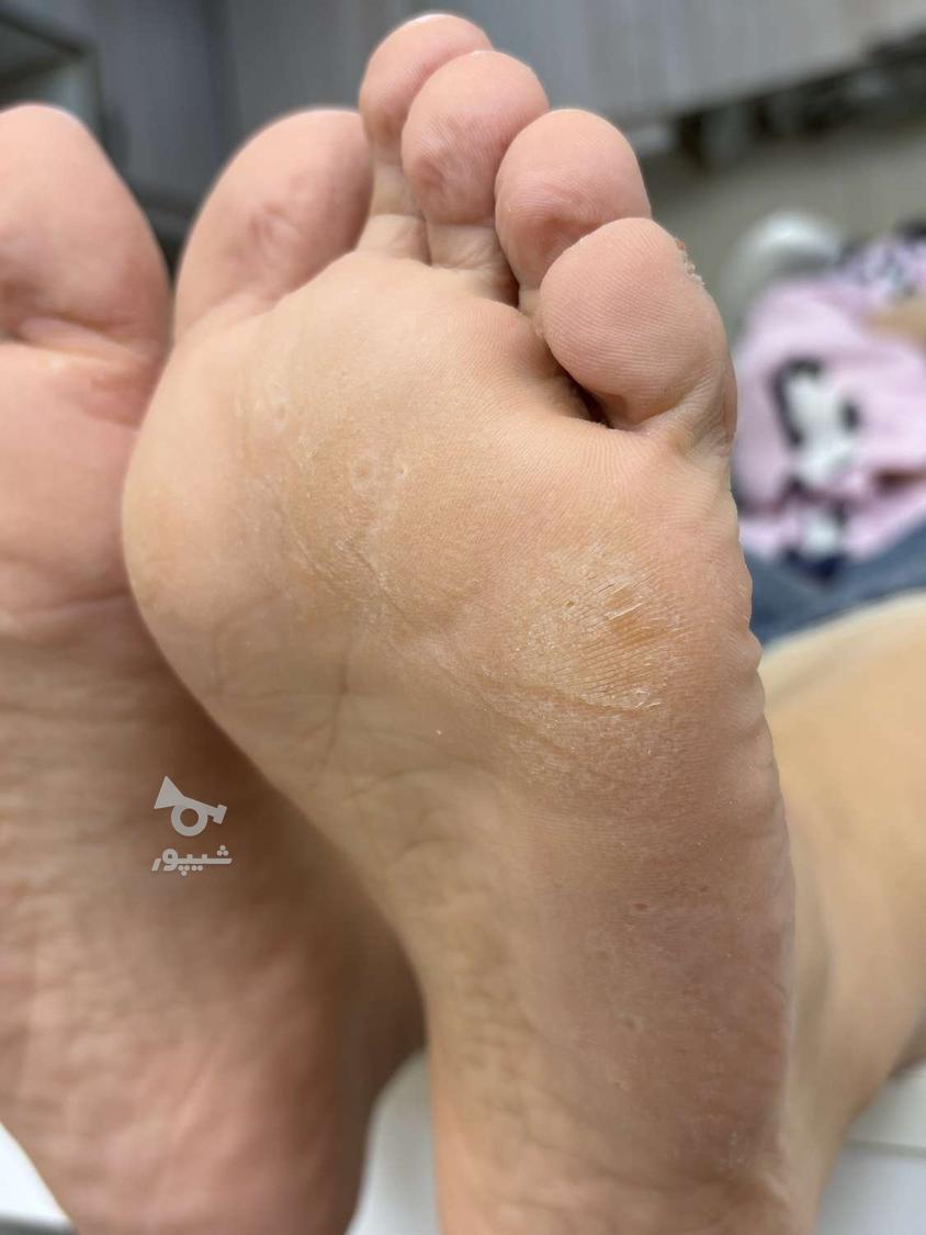 درمان ترک پا