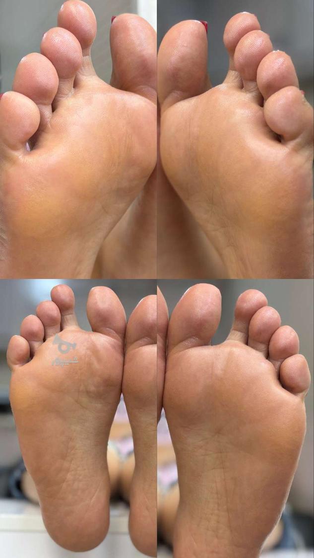 درمان ترک پا