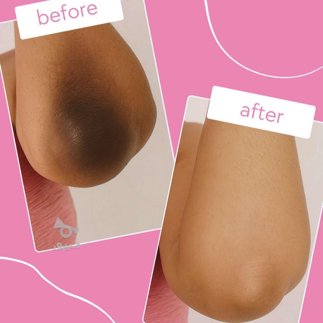 درمان دائمی تیرگی بدن ( بدون لیزر )