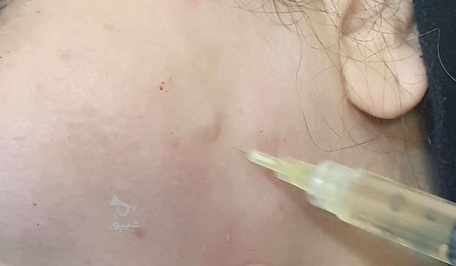 بوتاکس و جوانسازی کامل پوست