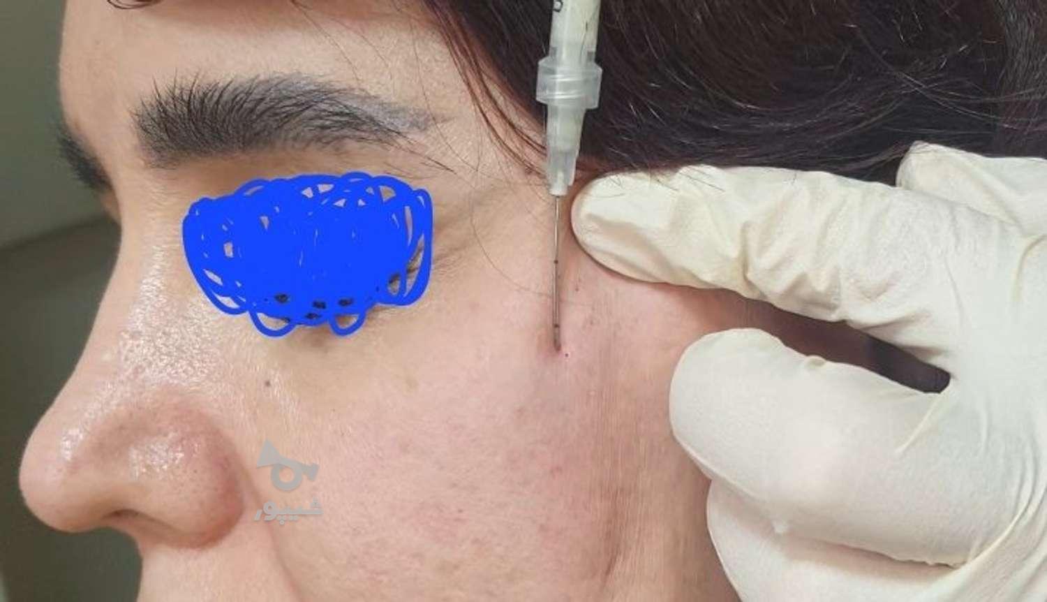 بوتاکس و جوانسازی کامل پوست