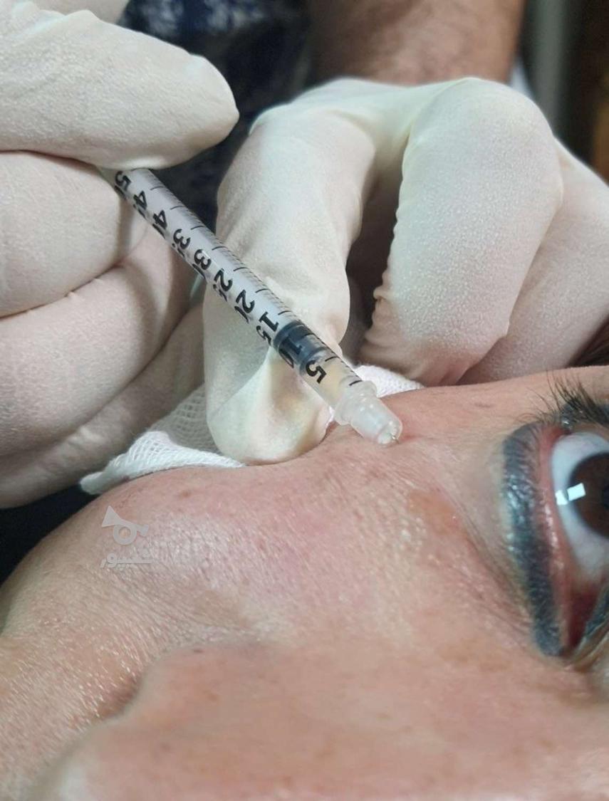 بوتاکس و جوانسازی کامل پوست