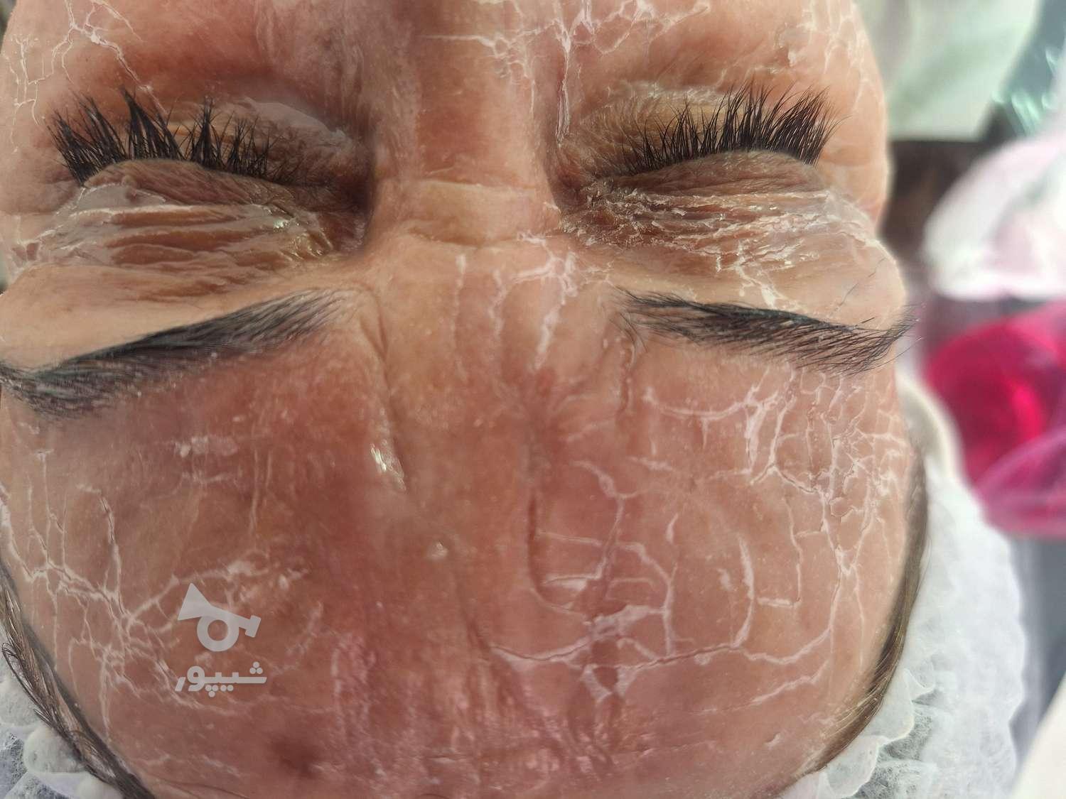 فیشال و پاکسازی صورت