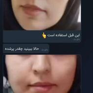 پک چاقی صورت