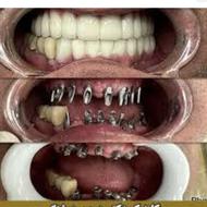 ایمپلنت کره ای دندان