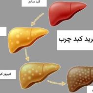 درمان قطعی انواع بیماری های کبدی به ویژه کبدچرب