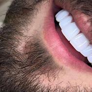 کامپوزیت فکی 6 تومن با بهترین متریال