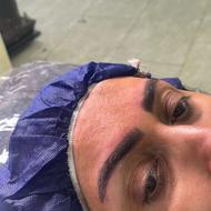 فیبروز ابرو با تخفیف ویژه 50٪یک هفته ای