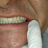 دندان مصنوعی /دندانسازی