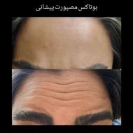 تزریق بوتاکس وژل