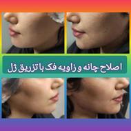 جشنواره تزریق ژل،بوتاکس،مزو،پی آرپی ولیفت ویژه روز مادر