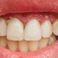 جشنواره ونیر کامپوزیت لبه شیشه ای