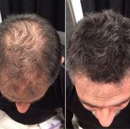 درمان قطعی ریزش مو با روش کاملاً گیاهی