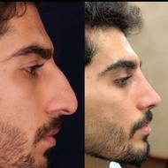 عمل بینی با تخفیف یلدایی