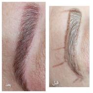 میکروبیدلینگ و میکروپیکپیتشن ابرو