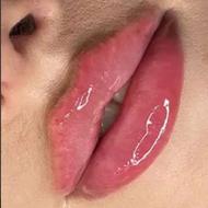 مدل ژل وبوتاکس