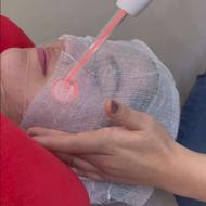 شفافتر از همیشه! پاکسازی حرفهای پوست با تخفیف وی