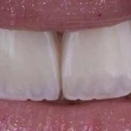 مدل کامپوزیت ونیر فقط هزینه مواد گرفته میشود