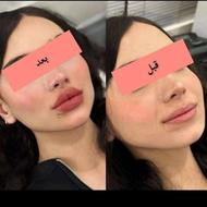 مدل برای ژل و بوتاکس رایگان