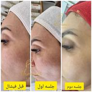 فیشیال وپاکسازی صورت با بهترین متریال