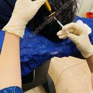 پی آر پی و مزوتراپی مو ،ابرو و پوست