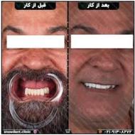 ایمپلنت با کیفیت و مناسبترین قیمت فرصت محدود