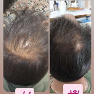 قطع ریزش مو با تونیک آریا پژوهش یکتا