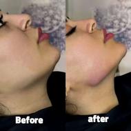 فیلر و ژل ویژه شب یلدا