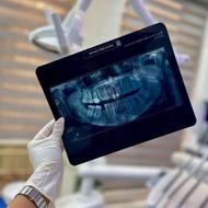 کامپوزیت/ایمپلنت/لمینت با 50 درصد تخفیف