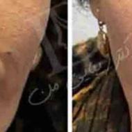 تخفیف ویژه یلدایی فیلر خط خنده و غم و چانه