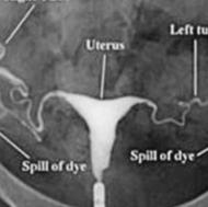 عکس رنگی رحم(HSG)