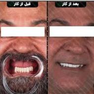 تخفیف ایمپلنت فقط تا یلدا