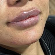 تذریق ژل و بوتاکس