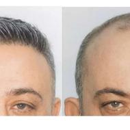 کاشت مو/کاشتموشیراز